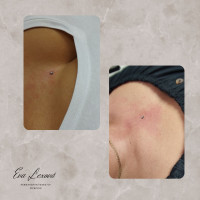 /album/fotogalerie-piercing/microdermal-mezi-prsa-jpg/